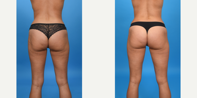 25-34 year old woman treated with BodyTite, Drainless Tummy Tuck, Liposculpture, Liposuction, Liposuction Revision, Mini Tummy T - Before and after REVISION tummy tuck, this patient was unhappy with her tummy tuck done by another surgeon. She had some excess skin, a visible incision, and a poor overall shape. I did a revision tummy tuck: 1. lowered her incision and removed excess skin 2. Re-tightened her abdominal muscles using a 3 vector corset plication to give her a flatter abdomen and cinched in waist 3. VASER 360 liposuction removes fat and tightens skin from her abdomen, flanks, and waist.