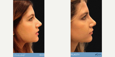 Woman treated with Rhinoplasty - Your nose, your choice! Opt for a surgeon who masters both open and closed rhinoplasty. Dr. Wolf delivers conservative, yet transformative results. Make the right decision for your journey!