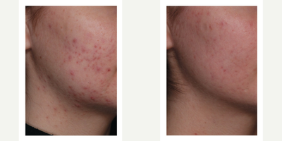 25-34 year old woman treated with Isolaz - Results following a series of Isolaz treatments paired with a prescribed topical therapy.
