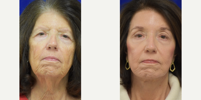 3478 Facelift, TCA Peel, Blue Peel, Brow Lift - 65-74 year old woman treated with Facelift, TCA Peel, Blue Peel, Brow Lift