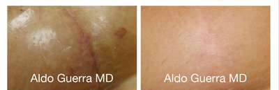 35-44 year old woman treated with Embrace Scar Therapy - Before and after embrace Active Scar Defense treatments for the vertical breast lift incision. Results shown at 8.5 months.