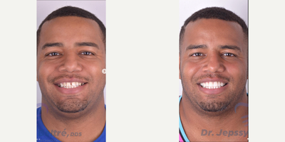 Man treated with Porcelain Veneers, Smile Makeover - Porcelain Veneers Natural color, shape and texture.
