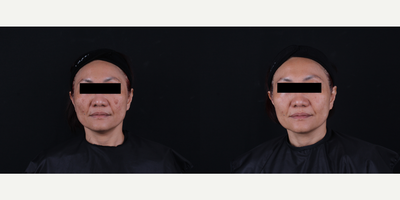 55-64 year old woman treated with Pico Genesis - Assessment: Melasma. Dermal-epidermal.Limitation: Patient had only 4-week time to spend for the treatment before returning home to work. Pico Genesis Skin Toning was performed in 4 sessions (once a week).Have been seeing phenomenal result after the 4th session.