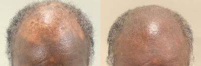 55-64 year old man treated with Scalp Micropigmentation - SMP performed to treat vitiligo combined with alopecia of the frontal scalp on a patient of African ethnicity.