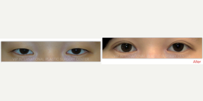 Asian Double Eyelid Surgery with Ptosis Correction & Magic Epicanthoplasty - Symptoms: Ptosis Symptom, Mono Eyelid, Mongolian Folds in the Front of EyesSurgery: Double Eyelid Incision Method & Magic EpicanthoplastySurgery Time: 1 HourRecovery Time: 1-2 Weeks
