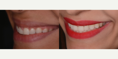 25-34 year old woman treated with Gum Lift - The excessive gingival display is a common condition where the teeth appear abnormally small causing an unattractive smile. Gum lifting was performed to reshape the gingiva.