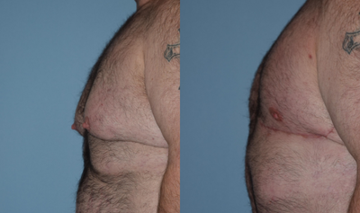 25-34 year old man treated with Gynecomastia Surgery - Male breast reduction with free nipple grafts, 2 months postoperative.