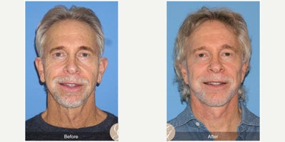 69 year old man treated with Lower Facelift, Neck Lift, Xeomin, PRP Injections - 69 year old man treated with Lower Face and Necklift, Fat Grafting with PRP to Malar and Forehead, Xeomin to Forehead