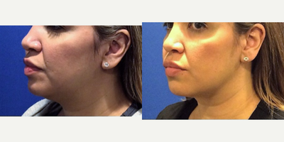 35-44 year old woman treated with Kybella - Patient treated for chin fat with 3 vials of Kybella.