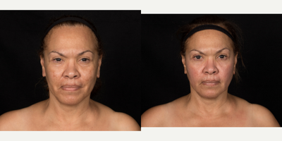 55-64 year old woman treated with Cosmelan - Patient treated with Cosmelan peel to improve color, texture, and tone