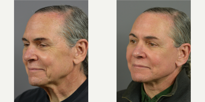 65-74 year old man treated with Mini Lift - Patient presented concerns regarding his neck. His neck concerns consisted of excess skin, sagging skin and turkey neck.  Examination revealed an acute neck/jaw angle.  There was moderate platysmal banding bilaterally at rest with no preplatysmal, preplatysmal or subplatysmal fat.  Moderate skin excess of the neck and moderate cervical skin laxity present.  There was also moderate jowl ptosis.An EZ- Lift Plus - Mini Facelift was recommended.  Seen in post-op at almost 1 year, the patient has no complaints and is pleased with his results.  Exam shows well healed scars and good facial contours.