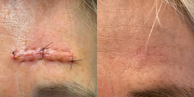 65-74 year old woman treated with Scar Removal - Scar revision after Mohs Surgery