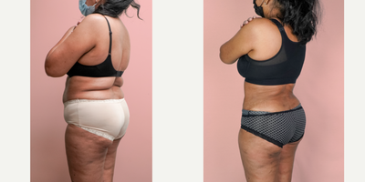 55-64 year old woman treated with Liposuction - This lovely patient requested help in improving her shape and removing the sagging skin from her abdomen. She was able to turn back the clock and look 30 years younger with a combination of tummy tuck and 360 liposuction.