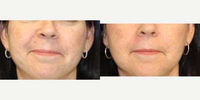 55-64 year old woman treated with Mole Removal - 55 year old woman was not happy with the appearance of the mole on her cheek- she has had it for many years and wanted it removed. She underwent an excision with two layer closure. Here she is 3 months later. She is very happy with the appearance of the area. You can watch the video of the procedure on my youtube channel.