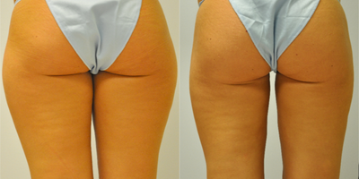 25 year old woman treated with Smart Lipo - 25 year old female treated with SmartLipo of the inner and outer thighs.