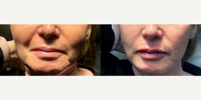 55-64 year old woman treated with Lip Threading - Lip PDO thread