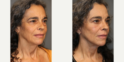 Lower Facelift and Eyelid Surgery - Minimally invasive lower facelift with eyelid surgery.