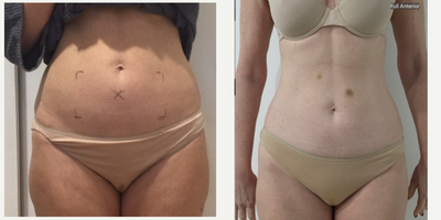 45-54 year old woman treated with truSculpt 3D, Skin Tightening, Carboxytherapy, Skin Rejuvenation - Female wanting to slim lower belly. Trusculpt 3D and Carboxy therapy were used. Single session of trusculpt and 1 weekly sessions of Carboxytherapy post trusculpt to speed results.