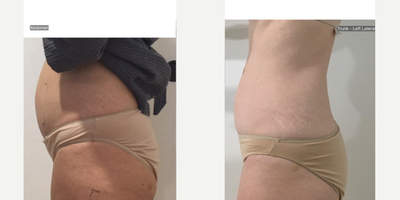 55-64 year old woman treated with truSculpt 3D, Skin Tightening, Carboxytherapy, Skin Rejuvenation - Female wanting to slim lower belly and saddlebag Trusculpt 3D and Carboxy therapy were used. Single session of trusculpt and 1 weekly sessions of Carboxytherapy post trusculpt to speed results.