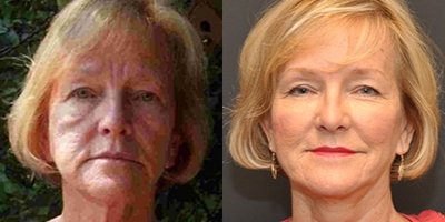Woman treated with Perlane - Injectable Fillers