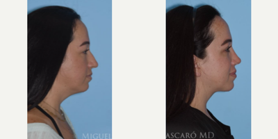 Woman treated with ThermiTight - Woman treated with Eyelid Surgery through upper blepharoplasty, Rhinoplasty, Buccal Fat Removal, ThermiTight, and Chin Liposuction to create definition and improve the cervicomental angle.Patient is shown before and 9 months post-op.