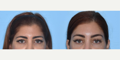 Woman treated with Brow Lift - Woman treated with endoscopic Brow Lift