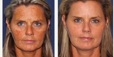 Fraxel Laser by Dr. Groff - Fraxel Laser by Dr. Groff