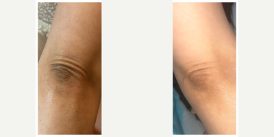 35-44 year old woman treated with VI Peel - 2 weeks following one session of VI Body Peel!