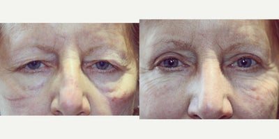 67 year old woman treated with Blepharoplasty Surgery - 67 year old woman treated with Blepharoplasty Surgery, to remove excess skin from the eyelids. Thus reducing sagging eyebrows, droopy upper lids and bags under the eyes.