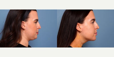 29 year old woman treated with myellevate - 29 year old woman treated with myellevate . Photos depict before and 1 week after surgery