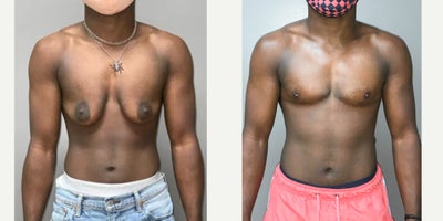 18-24 year old man treated with FTM Chest Masculinization Surgery - Our patient received a Female-to-Male Top surgery by Dr. Z at HZ Plastic Surgery. Results are only 6 weeks post-op.