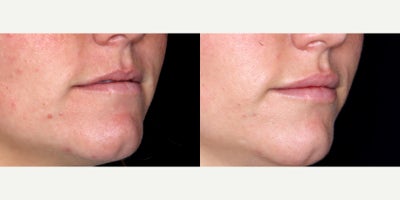 29year old woman treated with Volbella - 29year old woman treated with Volbella, Lip Fillers. Photos depict before and 2 weeks after treatment.