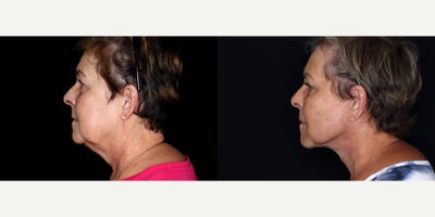 65 year old woman treated with Cheek Lift - 65 year old woman treated with Facelift, Neck Lift, Eyelid Surgery, Cheek Lift, Facial Fat Transfer. Photos depict before and 3 months after surgery.