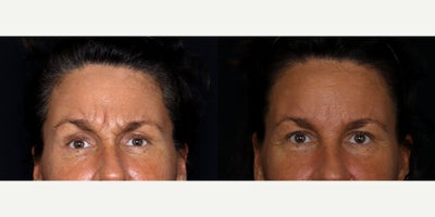 50 year old woman treated with Restylane Lyft to glabella - 50 year old woman treated with Restylane Lyft to glabella. Photos depict before and 1 month after treatment.