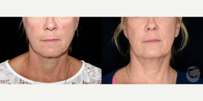 54 year old woman treated with Thread Lift - 54 year old woman treated with Thread Lift with Silhouette INstalift sutures. Photos depict before and 1 year after treatment.