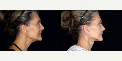 64 year old woman treated with Genioplasty (reduction) and necklift. - 64 year old woman treated with Genioplasty (reduction) and necklift. Photos depict before and 1 month after surgery.