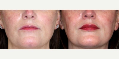 40 year old woman treated with Lip Fillers - 40 year old woman treated with Lip Fillers. Photos depict before and after 1 syringe of restylane Kysse.