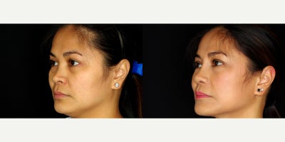 38 year old woman treated with Asian Rhinoplasty. - 38 year old woman treated with Asian Rhinoplasty. Photos depict before and 10 months after surgery.