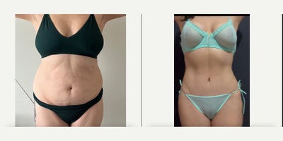 Woman treated with Mommy Makeover - Woman treated with Mommy Makeover