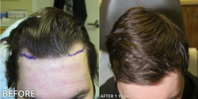 Man treated with Hair Transplant, ARTAS Robotic Hair Transplant - Man treated with Hair Transplant, ARTAS Robotic Hair Transplant