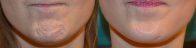 18-24 year old woman treated with Dysport - Before and after neuromodulation for dynamic (movement wrinkles).  Improved results in active wrinkling without an unnatural appearance is seen.