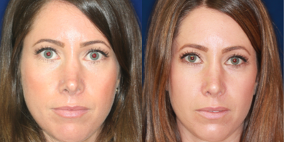 25-34 year old woman treated with Nonsurgical Nose Job, Silicone Injections, Silikon 1000 - Permanent Non- surgical Revision Rhinoplasty after overdone surgery. Bridge raised by gradual filling, particularly just above the tip. Refashioning the pinched, overdone tip.