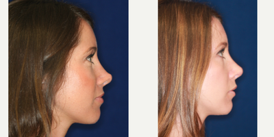 25-34 year old woman treated with Nonsurgical Nose Job, Silicone Injections, Silikon 1000 - Permanent Non- surgical Revision Rhinoplasty after overdone surgery. Bridge raised by gradual filling, particularly just above the tip. Refashioning the pinched, overdone tip.