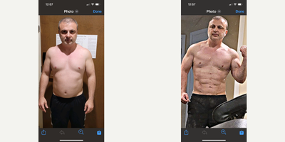 45-54 year old man treated with Abdominal Etching - 46 year old male who exercised regularly and good not get abdominal definition. Patient had HiDef abdominal and arm etching.
