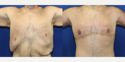 25-34 year old man treated with Gynecomastia Surgery - This is a 27 year old White patient who is 64 and weighed over 500 pounds.  He lost over 270 pounds through diet and exercise. He was not happy with the excess skin and fat in his breasts.  He traveled from Florida to California to have gynecomastia surgery, aka male breast reduction with Dr. J. Timothy Katzen.  He also had a horizontal torsoplasty and arm lift surgery at the same time. He is very happy with the results of the surgeries.