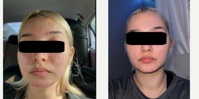 18-24 year old woman treated with Accutane - Accutane, also known by its generic name isotretinoin, is a medication primarily used to treat severe acne, specifically nodular or cystic acne that hasn't responded to other treatment methods. It belongs to a class of drugs known as retinoids, which are derivatives of Vitamin A.Treatment Process:The treatment length with Accutane varies typically from 16 to 20 weeks. During this time, patients take one or two pills daily with food. The dosage is determined by the patient's body weight and the severity of the acne.