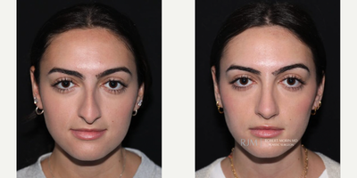 Woman treated with Rhinoplasty - Woman treated with Rhinoplasty