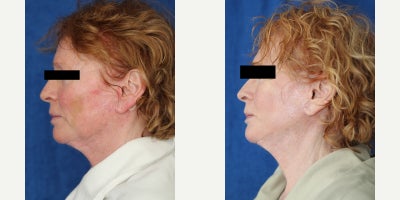 Surgical Removal of Facial Silicone Injection Improves Lips, Cheeks, and Comfort - Silicone injection removal of the face can restore a softer, healthier appearance when old foreign material begins causing swelling, discoloration, and discomfort. Our patient is a 64-year-old White female who had silicone injections placed in her cheeks and upper and lower lips 19 years ago. Over time, she developed facial swelling, changes in skin color, and pain related to the injected product, which led her to seek treatment from Dr. J. Timothy Katzen. Under general anesthesia, Dr. Katzen performed surgical silicone removal of the face, specifically treating the cheeks and both lips. This facial reconstructive procedure involves carefully opening the affected areas, identifying the silicone and surrounding scar tissue, and removing as much problematic material as safely possible while preserving natural facial structure. Silicone injections in the face can trigger chronic inflammation, firmness, irregular texture, visible distortion, and discoloration that do not improve without surgery. By removing the foreign material and refining the damaged tissue, this type of facial silicone removal surgery can improve comfort, contour, and skin appearance. Her photos were taken 3 months after surgery and already show remarkable results, including less swelling, improved color, and a more natural facial contour. She is also relieved of most of her pain, which makes her outcome especially meaningful.