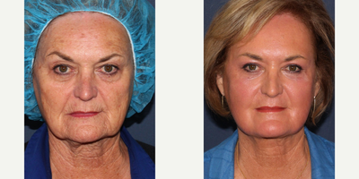 65-74 year old woman treated with ThermiTight - This 69 year old patient of Dr. Groff's was treated with a combination of the latest generation Lumenis Ultrapulse Encore C02, Sciton Erbium, Vbeam Perfecta, and Cynosure Accolade alex lasers. Her neck was treated for tightening at jawline and under chin with the ThermiTight device. All this was done in one day, in one treatment. Notice the dramatic reduction in wrinkles around the mouth and tightening around eyes and neck, which will continue to improve over the next few months.