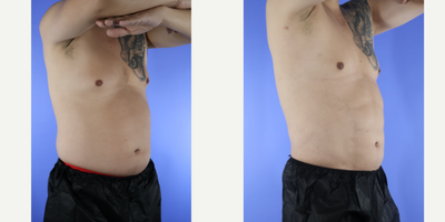 45-54 year old man treated with Liposuction, Abdominal Etching - Patient is 3 months post HiDef liposuction with abdominal etching. Patient wanted to get a head start in the gym. Patient loves his results. He looks amazing.